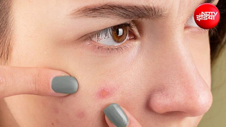 क्या हर पिंपल पर असरदार होते हैं Pimple Patch? डर्मेटोलॉजिस्ट से जानिए कैसे करें इस्तेमाल