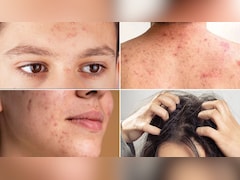 माथे, ठुड्डी, कमर और स्कैल्प...बॉडी के किस पार्ट पर एक्ने होने पर क्या लगाएं? Dermatologist से जानें