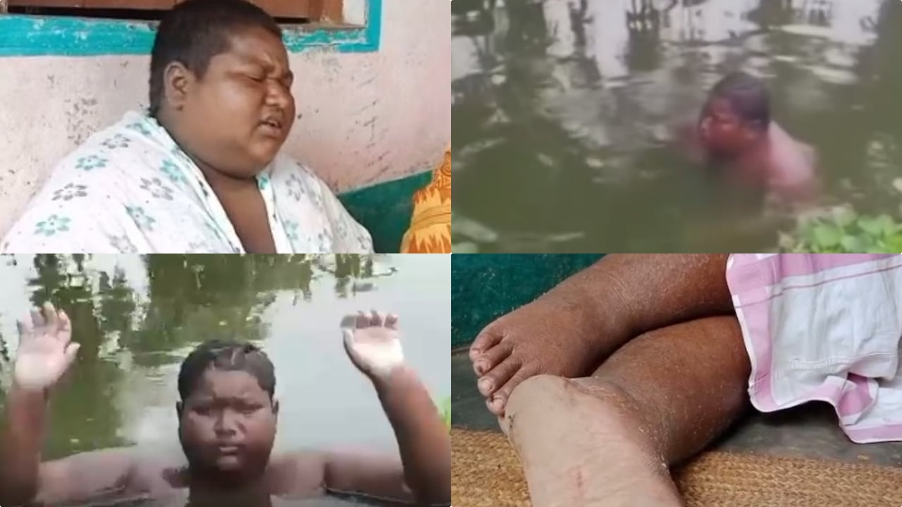 बीमार भी, लाचार भी...जलन का नहीं मिला इलाज, सालों से खुद को तालाब में डुबोए है किशोर