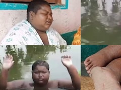 बीमार भी, लाचार भी...जलन का नहीं मिला इलाज, सालों से खुद को तालाब में डुबोए है किशोर
