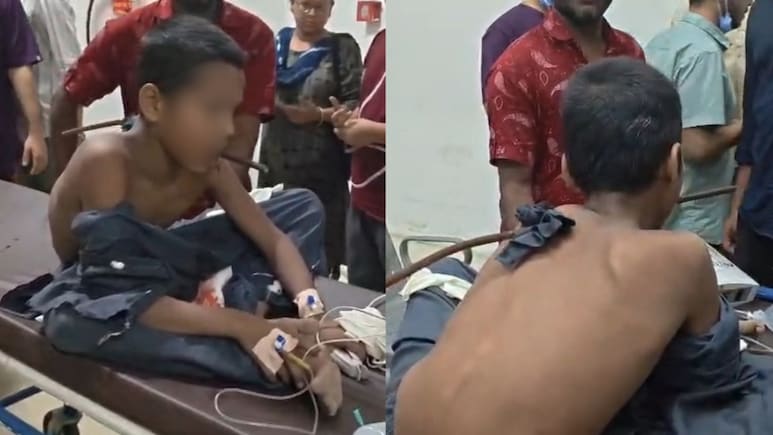 Boy Survives After Iron Rod Pierces Shoulder, Comes Out Of Mouth In Surat