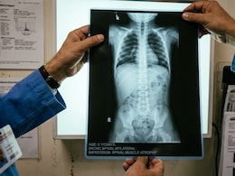 At 5 Months, Baby Rishwanth Is Fighting A Severe Spinal Disorder And A Race Against Time