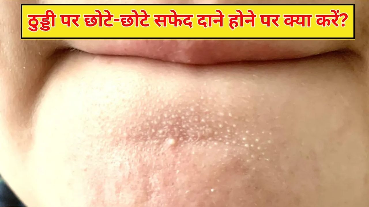 ठुड्डी पर होने वाले छोटे-छोटे सफेद दानों को घर पर कैसे ठीक करें? स्किन एक्सपर्ट ने बताया
