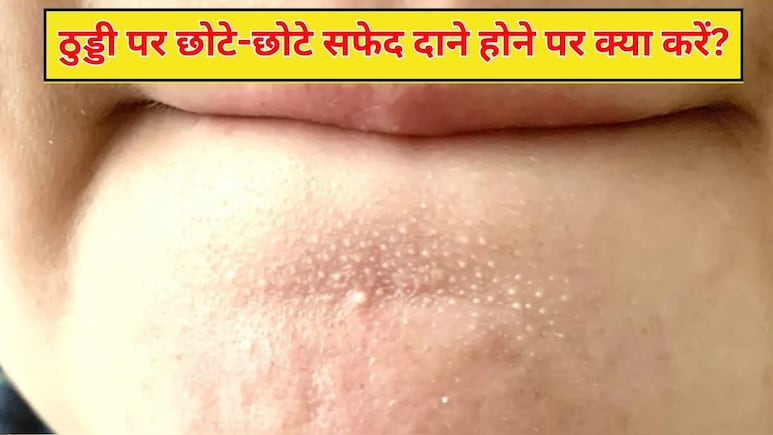 ठुड्डी पर होने वाले छोटे-छोटे सफेद दानों को घर पर कैसे ठीक करें? स्किन एक्सपर्ट ने बताया