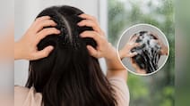 Expert Ki Rai: मानसून में डैंड्रफ से बचने के लिए हफ्ते में कितनी बार बाल धोने चाहिए
