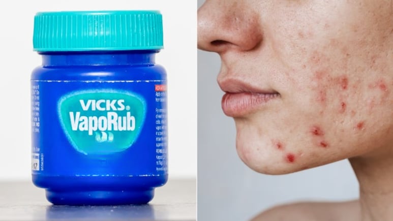 क्या Vicks लगाने से Pimple ठीक हो जाते हैं?