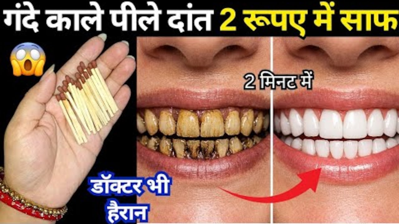 सिर्फ 2 रुपये में गंदे सड़े पीले दांतों को मोती की तरह चमका देगा ये असरदार देसी नुस्खा, मिनटों में दिखेगा असर