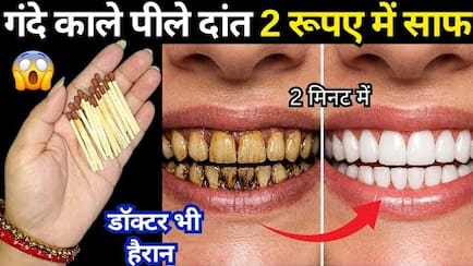 सिर्फ 2 रुपये में गंदे सड़े पीले दांतों को मोती की तरह चमका देगा ये असरदार देसी नुस्खा, मिनटों में दिखेगा असर