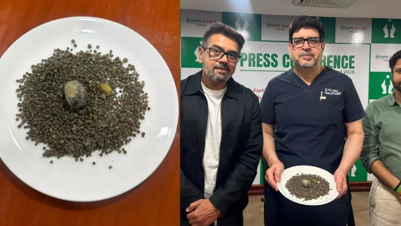 गॉल ब्‍लेडर में 4000 से ज्यादा पथरी और 46 BMI वाला मरीज! फरीदाबाद के फोर्टिस अस्पताल में डाक्टरो ने ऐसे बचाई जान