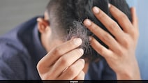 Ozempic Users Warned Over Hair Loss Linked to Weight Loss Jabs