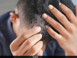 Weight Loss Medicines And Hair Loss: New Study Finds Genetic Link In Men