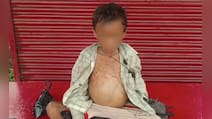 कुपोषण से 7 साल के आद‍िवासी बच्‍चे की मौत, डॉक्‍टर ने बताया क‍ितना खतरनाक और लक्षण