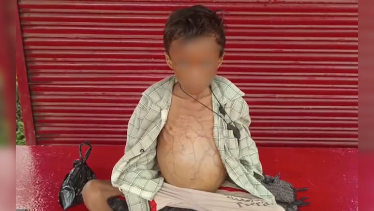 उमरिया में कुपोषण से 7 साल के मासूम की मौत, समय पर पोषण और उपचार नहीं मिलने के लगे आरोप