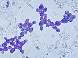 Over 3,400 Cases Of Candida Auris Reported Across 27 US States, Here's What You Need To Know About The Life-Threatening Fungus