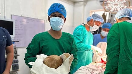 Doctors Remove 3.1 Kg And 17 Cm Urinary Bladder Stone From Patient