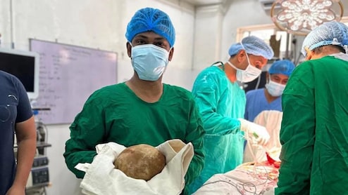 ब्लैडर से निकली 3.1 किलो की पथरी! शुतुरमुर्ग के अंडे जितने बड़े स्टोन ने डॉक्टरों को भी चौंकाया