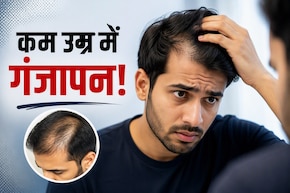 गंजेपन का डर या हैंडसम दिखने की चाहत? जानिए क्यों Gen Z युवा करा रहे हेयर ट्रांसप्लांट