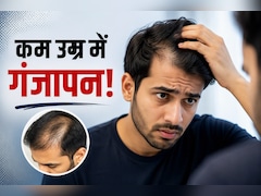 गंजेपन का डर या हैंडसम दिखने की चाहत? जानिए क्यों Gen Z युवा करा रहे हेयर ट्रांसप्लांट