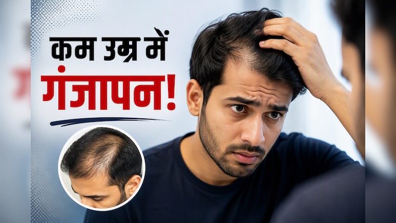 गंजेपन का डर या हैंडसम दिखने की चाहत? जानिए क्यों Gen Z युवा करा रहे हेयर ट्रांसप्लांट