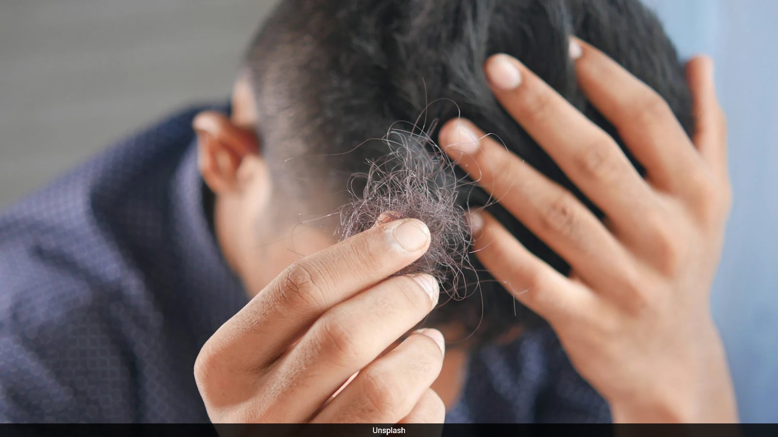 Arthritis Drug Shows Promise Restoring Hair in Severe Alopecia
