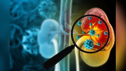 From 6,000 To Over 18,000: Karnataka Sees Rise In Death From Kidney, Urinary Diseases Over 10 Years| Report