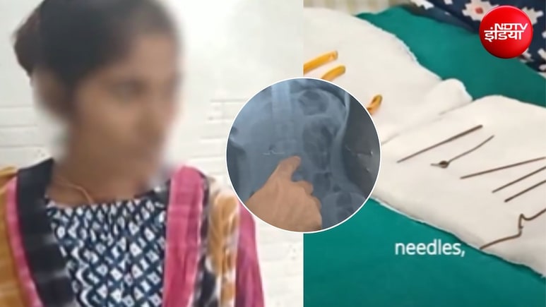 महिला के पेट से निकली 6 सुईयां, छलनी हो गई थी आंत,  इस बीमारी के चलते खा रही थी, कांच, मिट्टी... जैसी चीजें