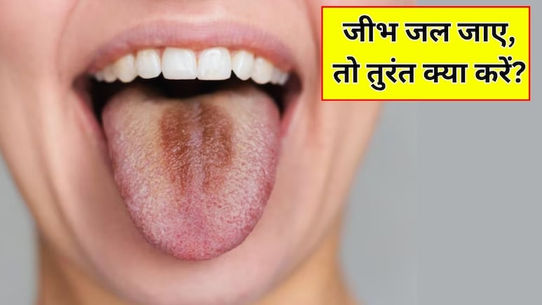 गर्म खाने से जीभ जल जाए तो तुरंत क्या करें? एक्सपर्ट ने बताया कैसे जल्दी होगी ठीक