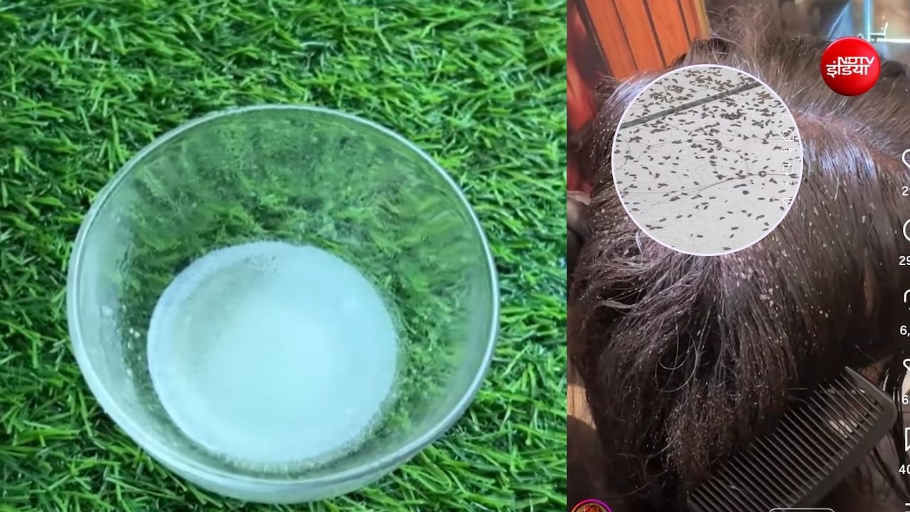 जुएं ने बालों को बना लिया है घर? इस 1 नुस्खे से सिर के सारे जूं हो जाएंगे खत्म