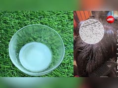 जुएं ने बालों को बना लिया है घर? इस 1 नुस्खे से सिर के सारे जूं हो जाएंगे खत्म