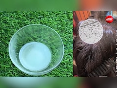 जुएं ने बालों को बना लिया है घर? इस 1 नुस्खे से सिर के सारे जूं हो जाएंगे खत्म