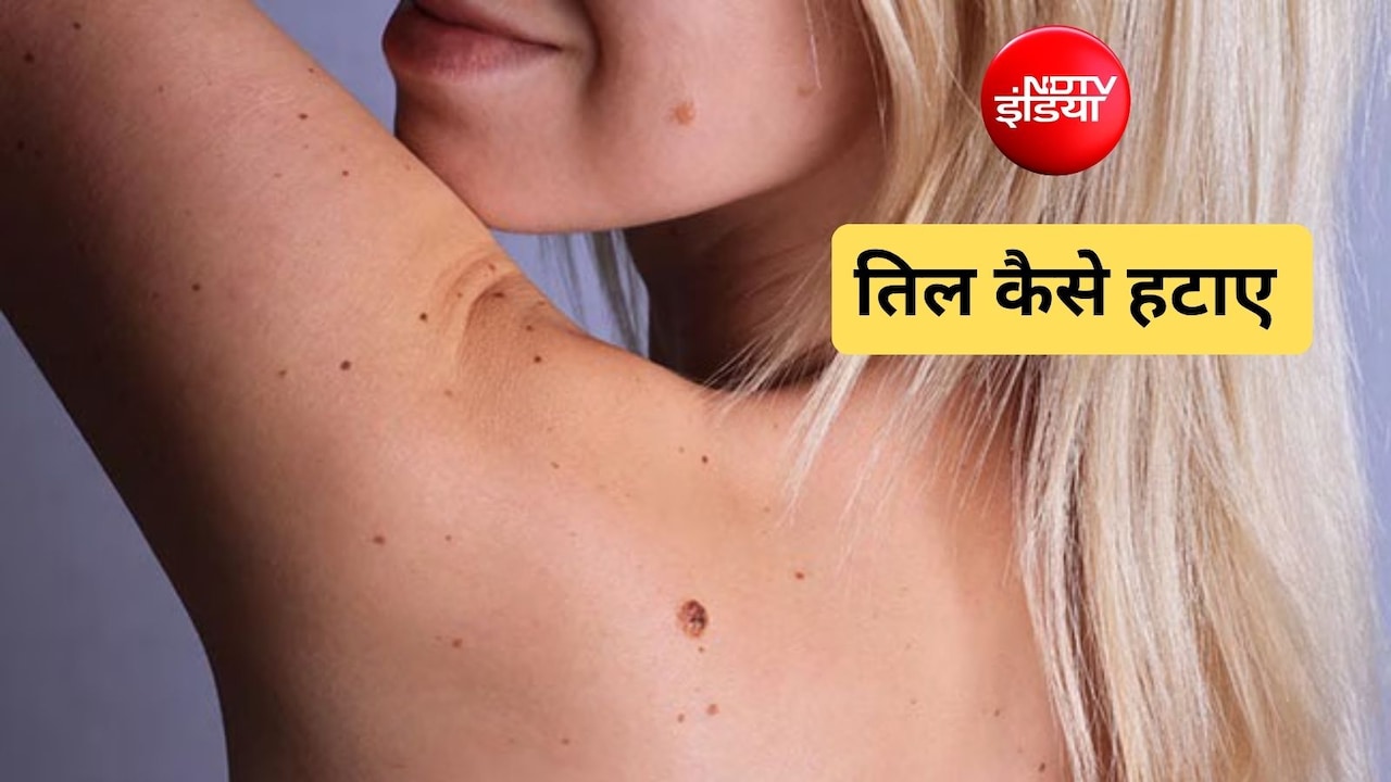 तिल को जड़ से खत्म कैसे करें? चेहरे से काले तिल हमेशा के लिए कैसे हटाएं, जान‍िए यहां