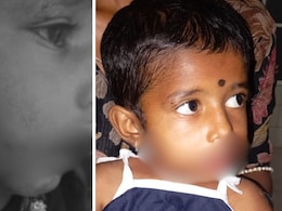 4-Year-Old Girl Attacked By Stray Dogs While Playing At Home In Karnataka