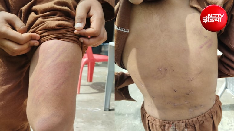 मदरसे में इतना पीटा कि भाग गया बच्चा, 30 किलोमीटर दूर सड़क पर भटकता मिला, पूरे शरीर पर मिले चोट के निशान