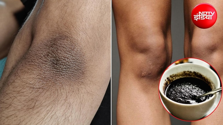 DIY Scrub: मैल से कोहनी और घुटने दिखने लगे काले? अपनाएं ये 3 होममेड स्क्रब, साफ हो जाएगी स्किन, चमकेगी त्वचा