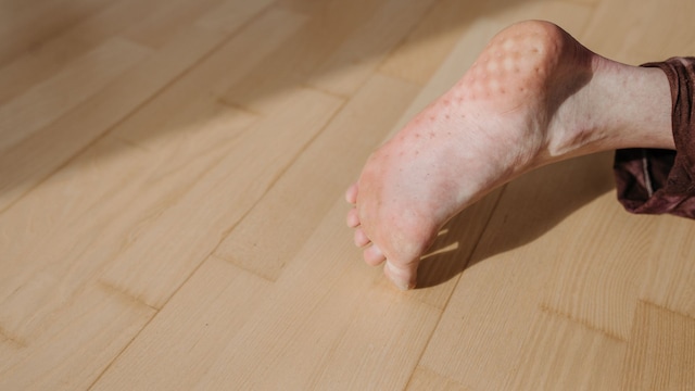 Heat boils on your feet can occur due to friction causing redness