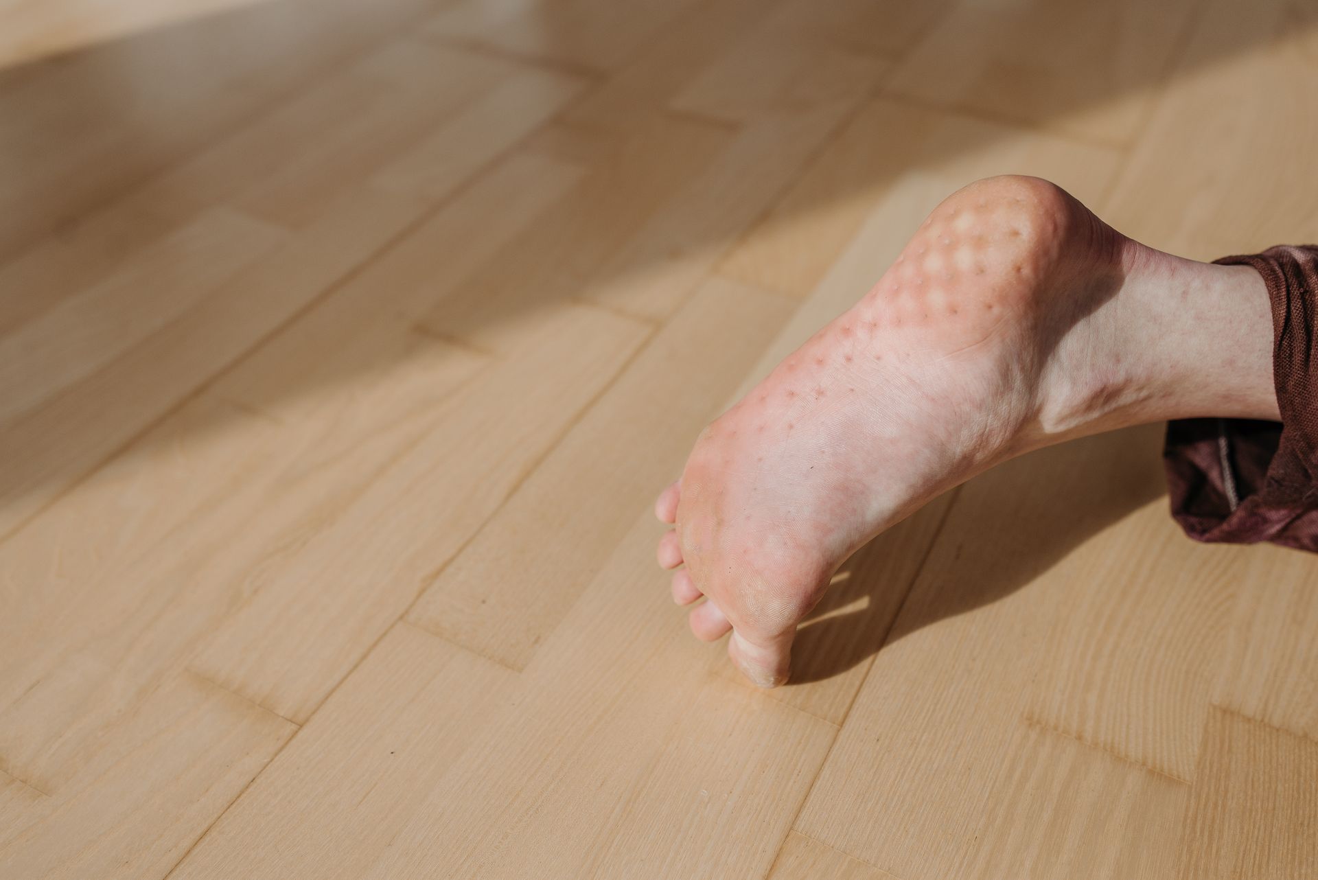 Heat boils on your feet can occur due to friction causing redness