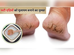 फटी एड़ियों पर क्या लगाएं? एक्सपर्ट ने बताया रात में लगाकर सो जाएं ये देसी चीज, पैरों की त्वचा हो जाएगी मुलायम