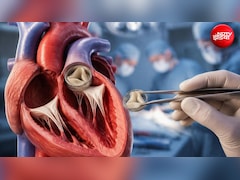 हार्ट वाल्व रिप्लेसमेंट सर्जरी कितनी गंभीर होती है? डॉक्टर से जानें जोखिम, रिकवरी और खर्च की पूरी डिटेल