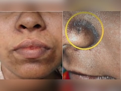 नाक और होंठों के आसपास से काली पड़ रही है त्वचा? एक्सपर्ट ने बताया क्या करने से साफ होगी स्किन