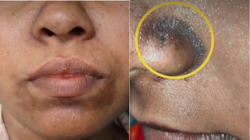 नाक और होंठों के आसपास से काली पड़ रही है त्वचा? एक्सपर्ट ने बताया क्या करने से साफ होगी स्किन