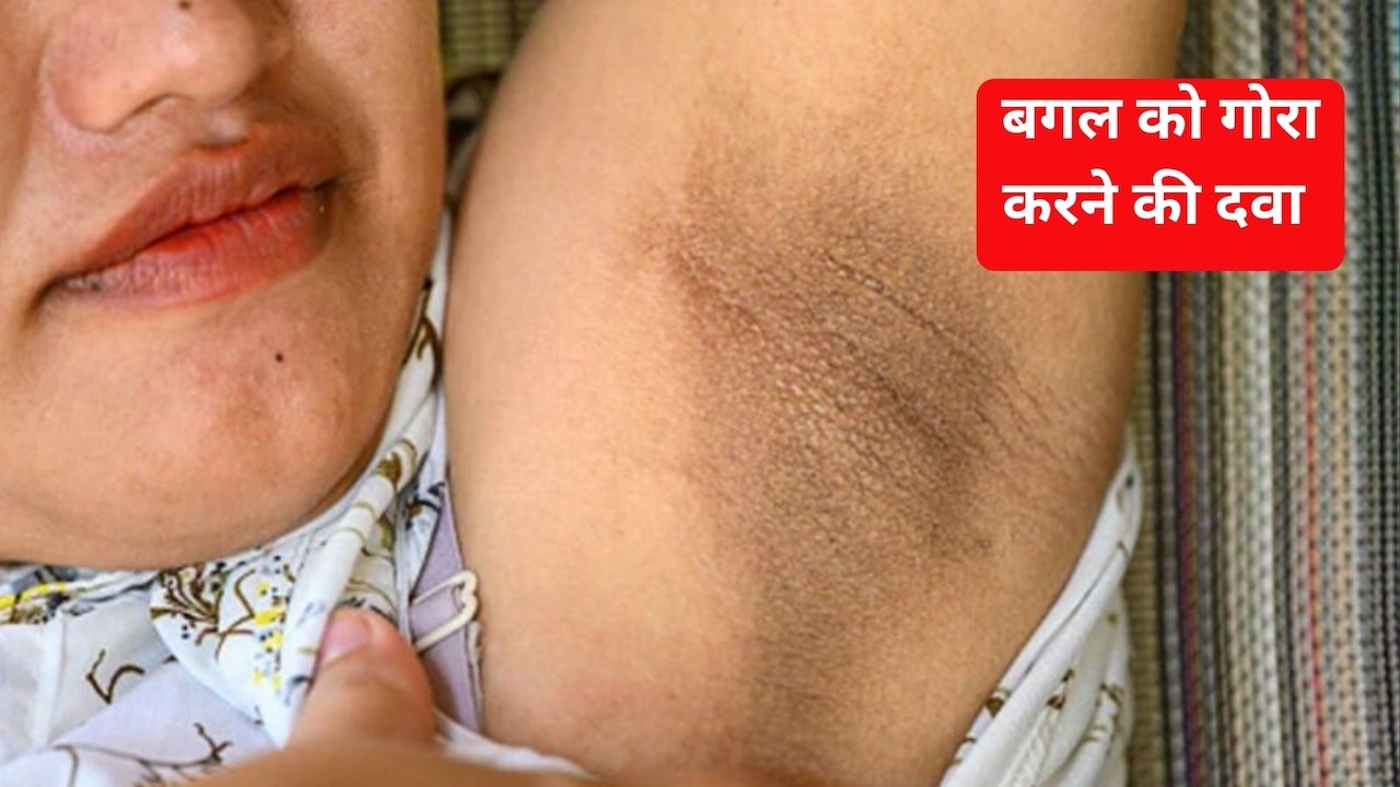 अंडर आर्म को गोरा करने के लिए क्या करें? बगल का कालापन दूर करने वाली दवा, जान‍िए यहां