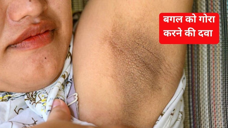 अंडर आर्म को गोरा करने के लिए क्या करें? बगल का कालापन दूर करने वाली दवा, जान&zwj;िए यहां