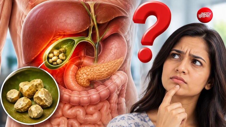 पित्त की पथरी का ऑपरेशन कब करवाना चाहिए?