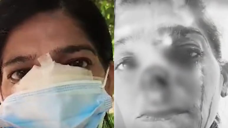 भीख देने से मना करने पर भिखारी ने गोवर्धन परिक्रमा कर रही महिला की दांत से काटी नाक