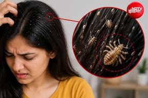 बालों की जूं सिर्फ खुजली नहीं, सेहत को भी पहुंचा सकती है नुकसान