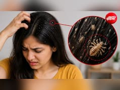 बालों की जूं सिर्फ खुजली नहीं, सेहत को भी पहुंचा सकती है नुकसान