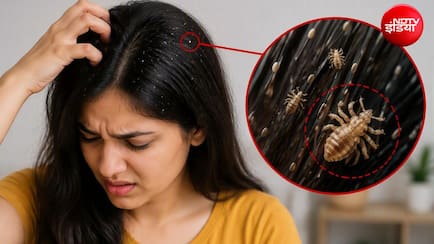 बालों की जूं सिर्फ खुजली नहीं, सेहत को भी पहुंचा सकती है नुकसान