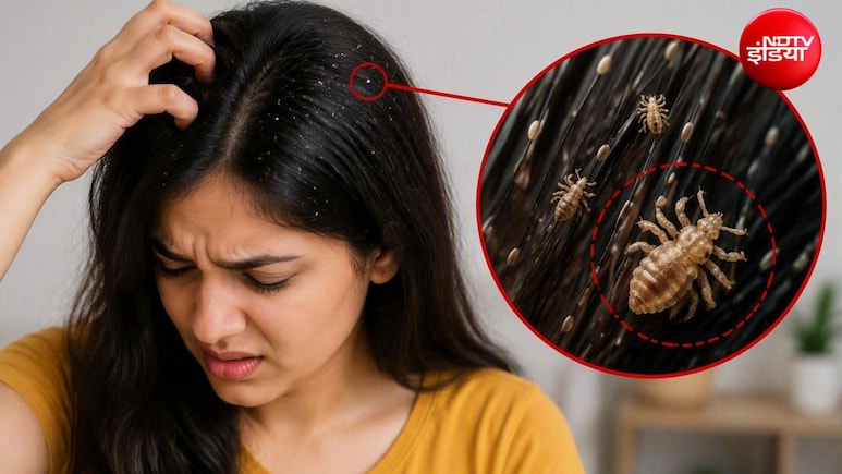 बालों की जूं सिर्फ खुजली नहीं, सेहत को भी पहुंचा सकती है नुकसान