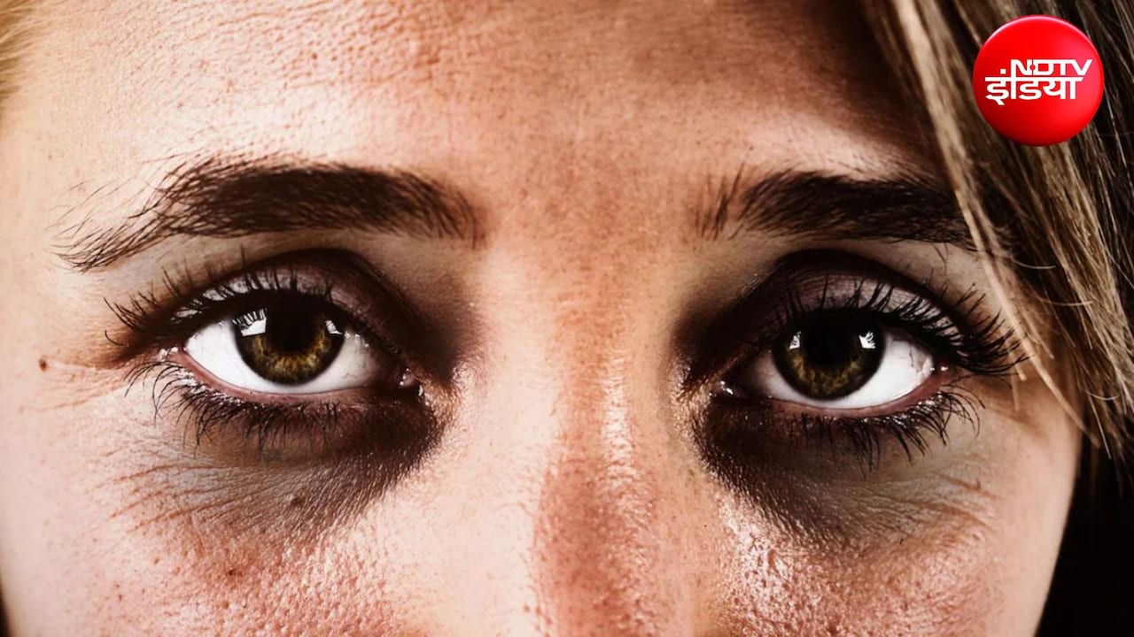भरपूर नींद के बाद भी क्यों रहते हैं डार्क सर्कल्स? एक्सपर्ट से जानिए Dark Circles से छुटकारा पाने के लिए क्या इस्तेमाल करें