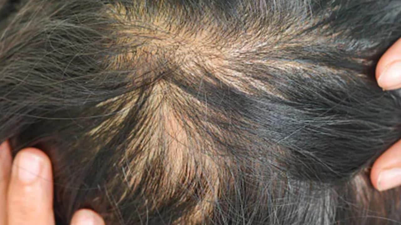 Hair Fall रोकने के लिए सिर्फ शैंपू-तेल काफी नहीं, जानिए हेयर फॉल कंट्रोल के लिए Scalp Care क्यों है जरूरी